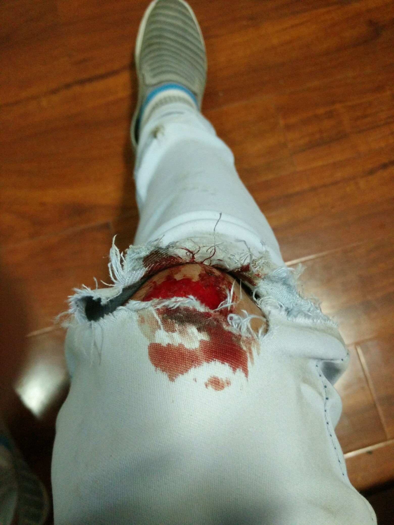 一觉醒来,腿肿的那么高