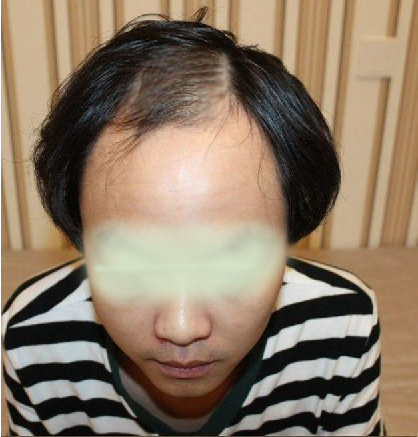 最近几年为什么总是掉发啊,男生也有更年期吗