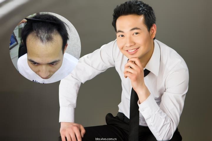 发际线后移都能怎么治发际线调整技术有用吗